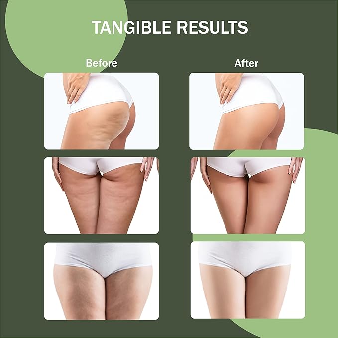 Cellulite Manual Massager - Lymphatic Drainage Massager with Detachable Handles - Reduce Cellulite and Stretch Marks on Legs and Body