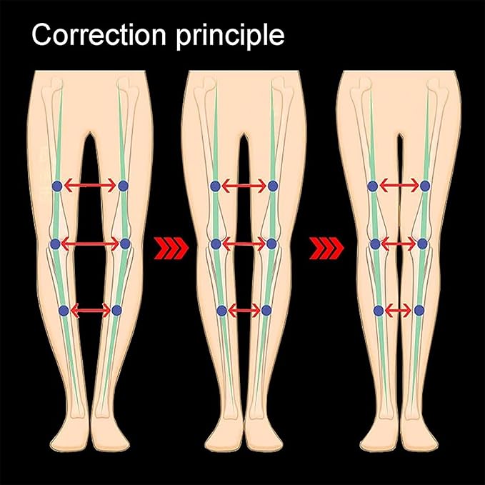O/X Type Leg Correction Belt-Adjustable Recovery Beauty Unisex O/X Legs Correction Belt Knock Knees Shape Straightening Bandage Straightening Leg